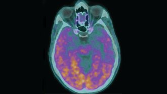 An image of a brain scan with glowing purple and orange spots that mark amyloid-beta.