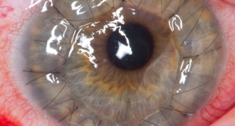 cornea transplant